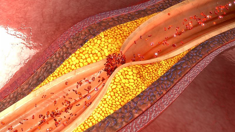 Reducir el colesterol mediante la edición genética