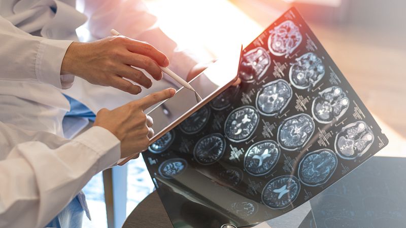 Descifran la clave para diagnosticar la epilepsia del lóbulo temporal