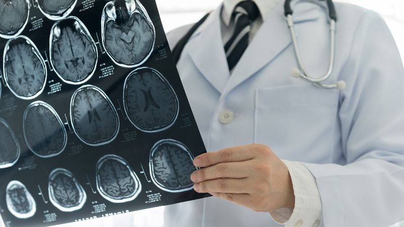 Descubren un gen clave para tratar el subtipo de cáncer cerebral más peligroso