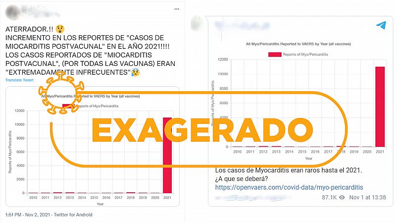 Miocarditis en vacunados contra la COVID-19, un posible efecto adverso de baja incidencia y buena evolucin