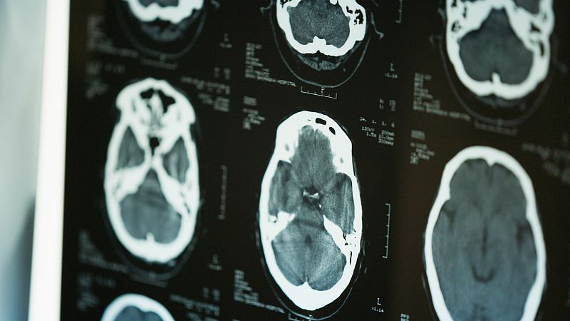 Pacientes y médicos acogen entre la esperanza y la cautela el estudio sobre el origen de la esclerosis múltiple