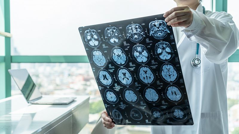 Científicos españoles descubren una proteína que protege al cerebro del alzhéimer