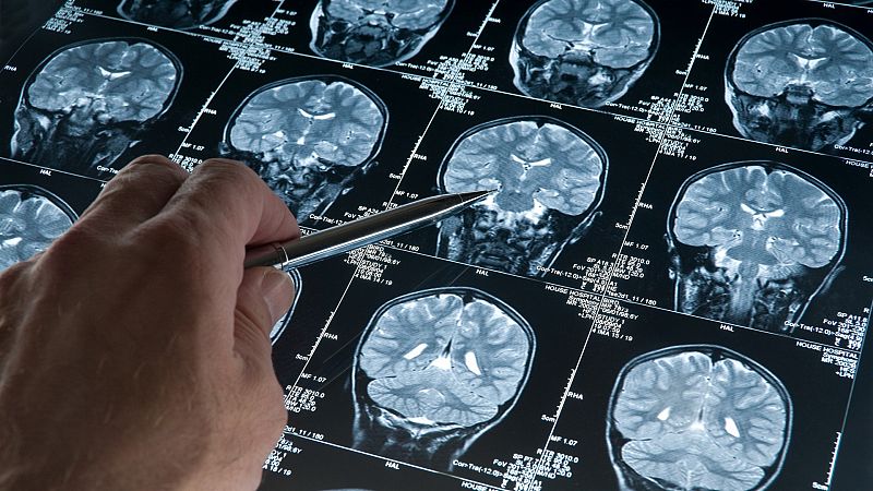 Prueban con éxito en ratones una terapia de células madre que remite el tumor cerebral más frecuente y agresivo