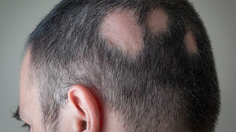 Estados Unidos aprueba el primer tratamiento contra una forma grave de alopecia