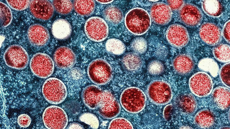 El 40 % de los pacientes de viruela del mono sufren complicaciones dolorosas que requieren tratamiento médico