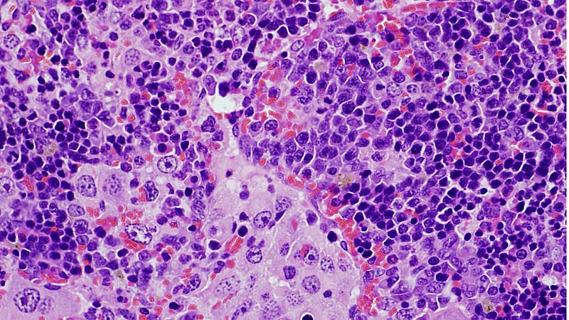 El CSIC revela una mutación genética clave en la aparición de linfomas y el cáncer de pulmón