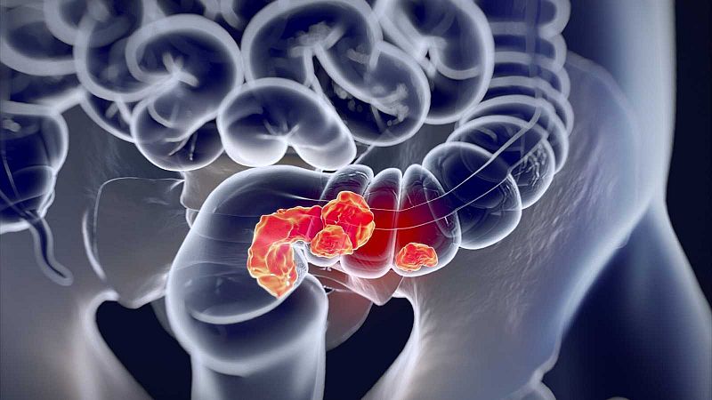 Científicos españoles identifican las células responsables de la recaída en el cáncer de colon