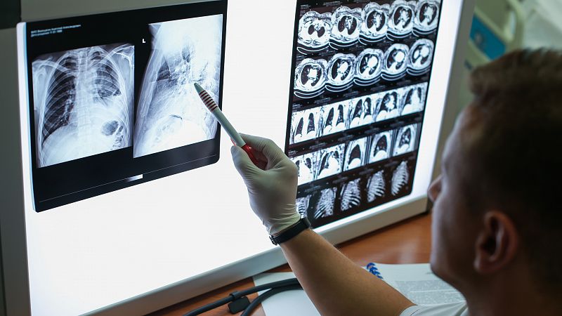 El impacto de la pandemia de COVID en el cáncer: Sanidad prevé más casos de pulmón, mama y colon