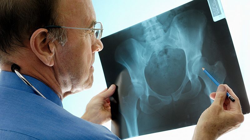 Osteoporosis: qué debemos comer para prevenirla