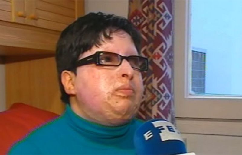 Una mujer iraní quemada con ácido decide aplicar ley del Talión a su verdugo