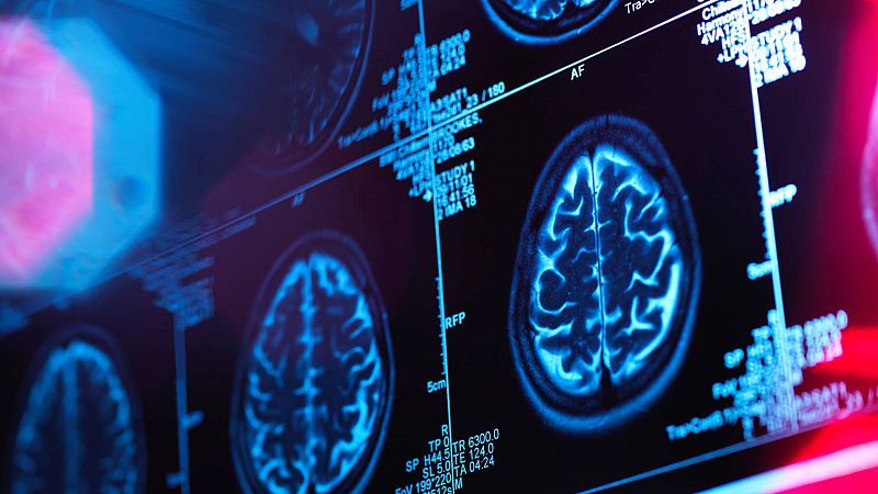 El prometedor medicamento contra el alzhéimer lecanemab podría encoger el cerebro de los pacientes