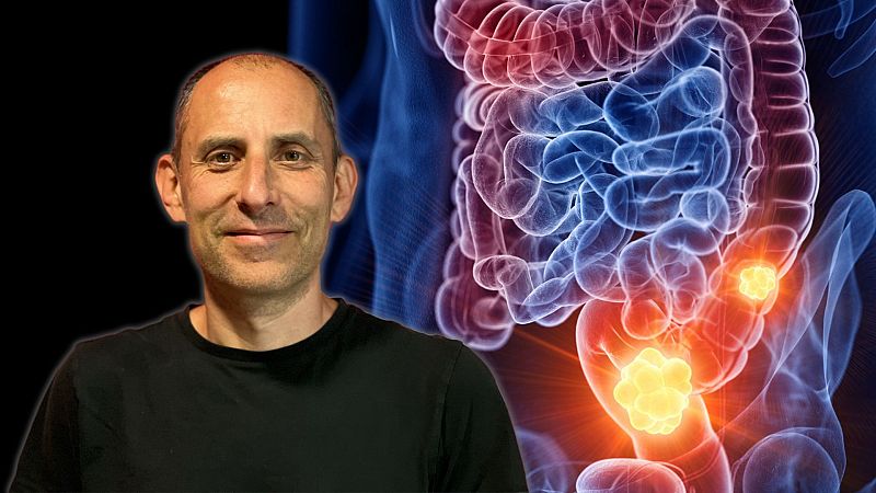 Cáncer colorrectal en menores de 55 años: ¿Por qué está aumentando?