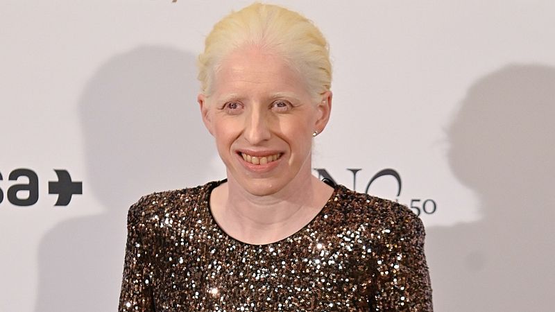 Qu es el albinismo?: Todo sobre esta condicin gentica que no es enfermedad y no tiene cura