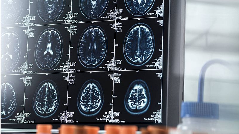 Un nuevo fármaco experimental contra el alzhéimer ralentiza el deterioro cognitivo un 35% en las primeras etapas