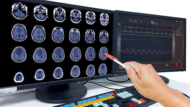 Una investigación de científicos españoles abre camino a la detección precoz de la metástasis cerebral
