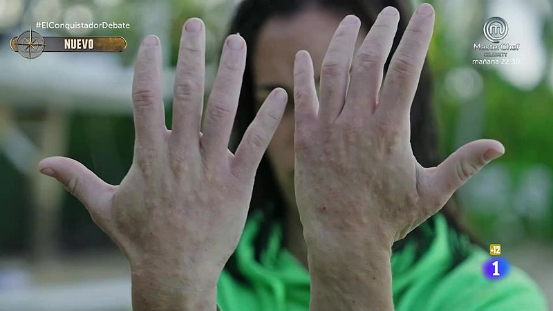 El Conquistador | Las picaduras del mosquito jején, la peor pesadilla de los concursantes