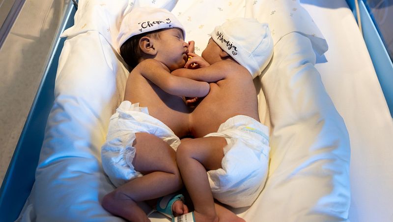 Coneixem la història de les germanes siameses separades amb èxit