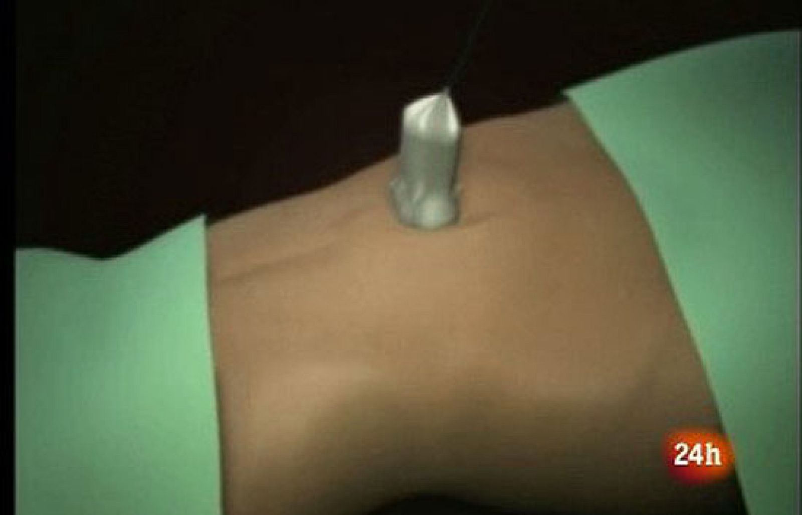 Extraen riñón a mujer desde ombligo - Ciencia y tecnología en Rtve.es | Ver