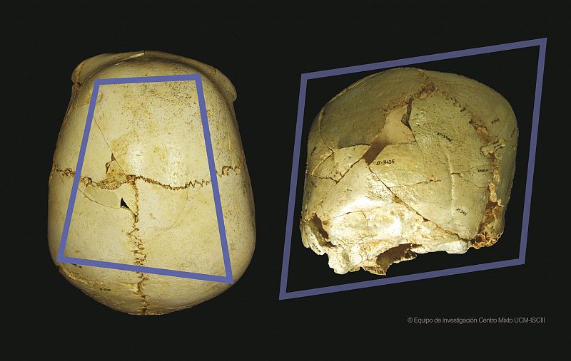 Hallan en Atapuerca un cráneo infantil de 530.000 años con una rara enfermedad congénita