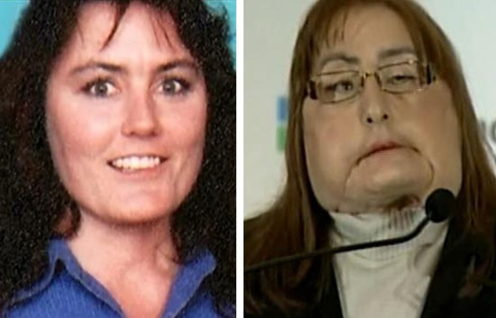 Más de 30 operaciones para recuperar un rostro - Ciencia y tecnología en Rtve.es | Ver