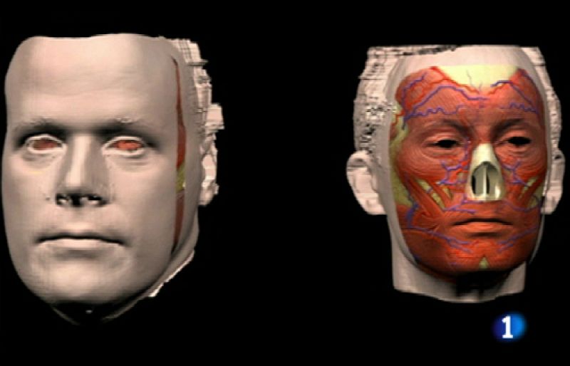 Termina el primer trasplante de cara de España tras más de 15 horas de intervención en Valencia