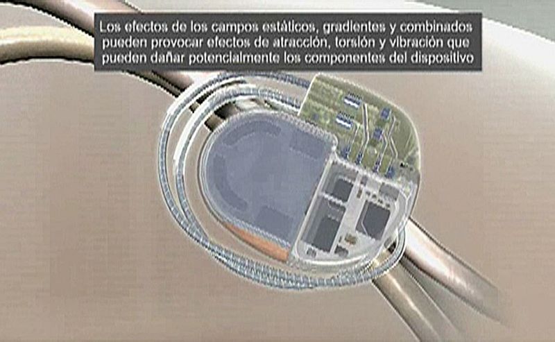 Implantan el primer marcapasos digital compatible con resonancia magnética de España