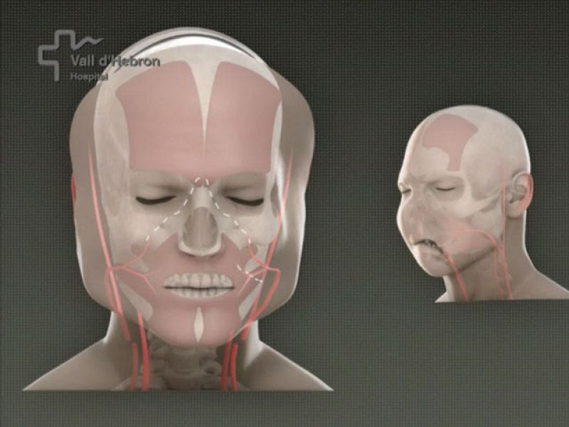 El trasplante de cara realizado en Barcelona es el primero "total" que se lleva a cabo en el mundo