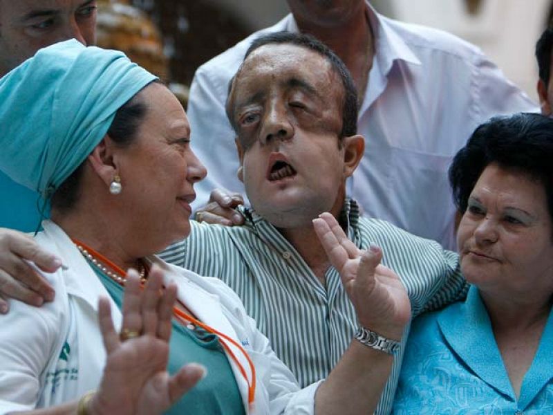 El primer trasplantado de cara español que muestra su rostro "se ve más joven" ahora