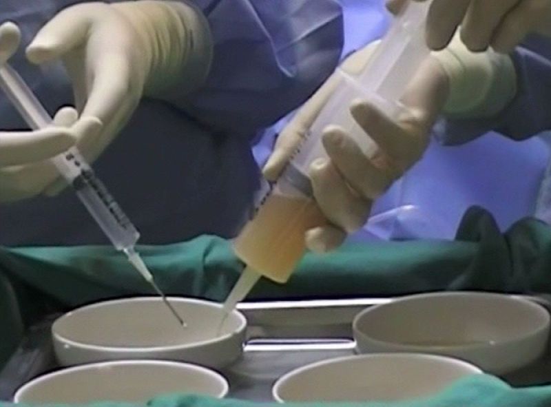 Científicos españoles desarrollan un gel que restituye la mama tras la extirpación de un tumor