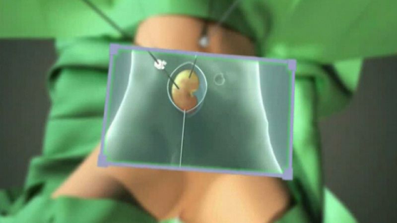 El Clínic de Barcelona aplica una nueva cirugía que facilita el trasplante de riñón en vivo