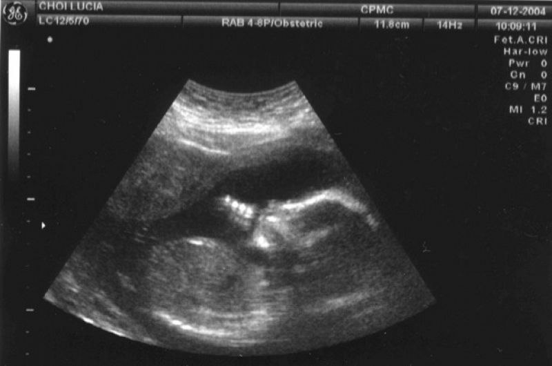 Un analisis de sangre permite conocer el sexo del feto a las 7 semanas de embarazo