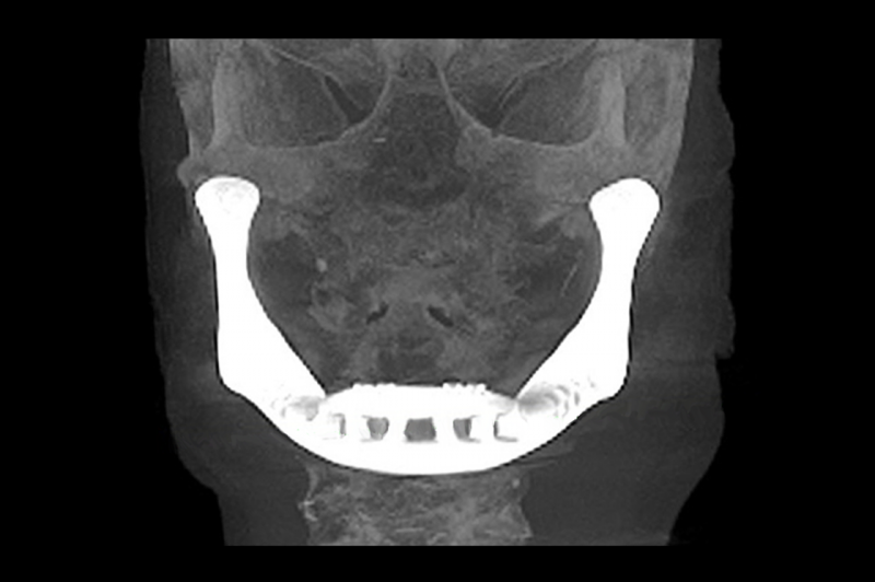 Trasplantan por primera vez una mandíbula artificial creada por una impresora 3D