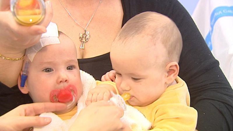 Operadas con éxito dos siamesas unidas por el abdomen que compartían hígado en Barcelona