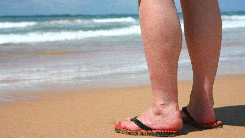 Cómo cuidar las varices en verano