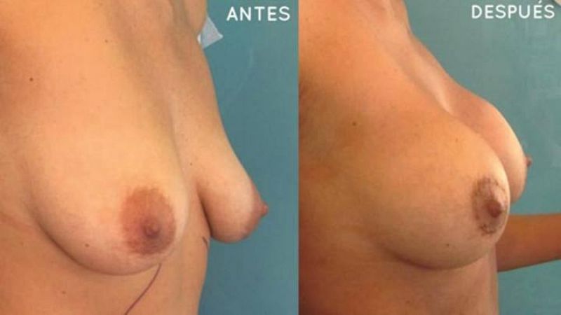 Lipotransferencias: quitar de donde sobra y ponerlo donde falta