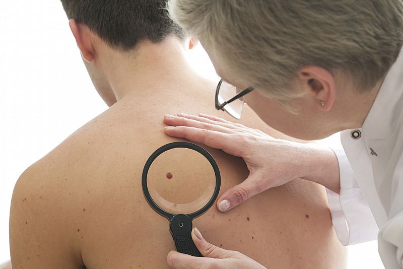 Las proteínas Vav pueden proporcionar dianas farmacológicas para el cáncer de piel