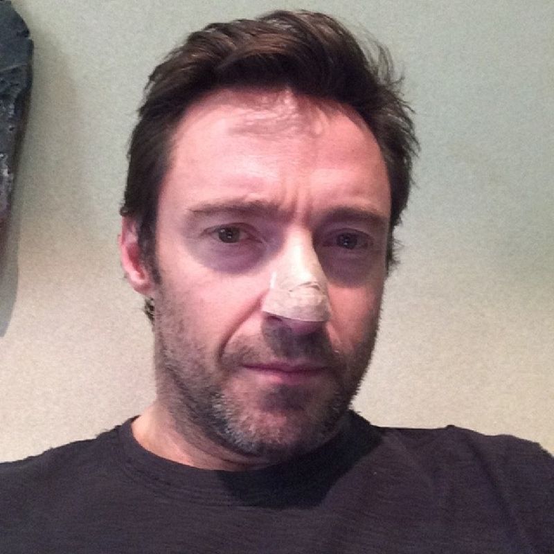 Hugh Jackman revela que padece un carcinoma en la nariz