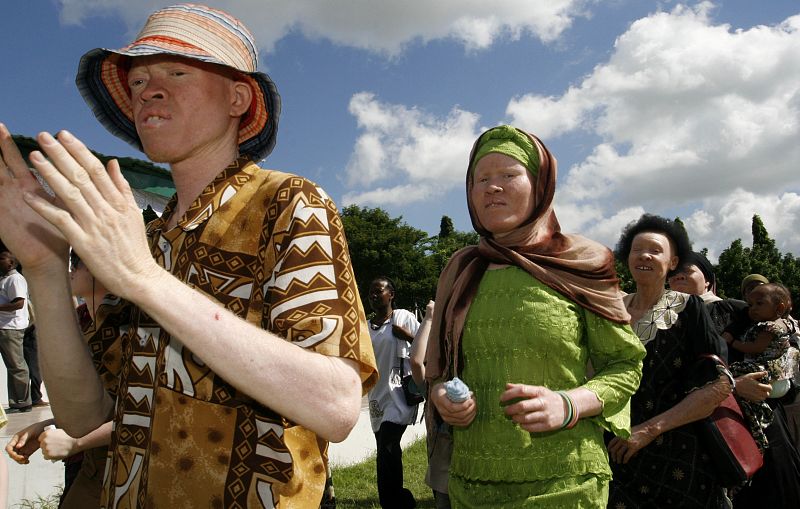 Los albinos, perseguidos en Tanzania por brujería