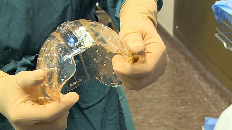 Implantan por primera vez un cráneo entero hecho con una impresora 3D