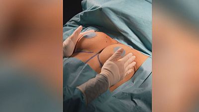 Cirugía estética de mama: torso de paciente en quirófano con marcas preoperatorias y apósitos. Manos enguantadas palpando el pecho. Cirugía estética de mama: torso de paciente en quirófano con marcas preoperatorias y apósitos. Manos enguantadas palpando el pecho.