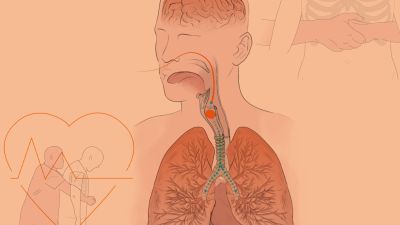 Atragantamientos en Navidad: cómo ocurren y cómo evitarlos