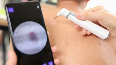 Avances en la detección del cáncer de piel: de los mapas 3D corporales o los robots digitales
