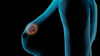 Las células del cáncer de mama se pueden 'silenciar', según investigadores españoles