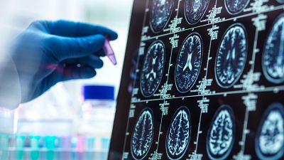 Científicos visualizan por primera vez el desencadenante del párkinson en el cerebro