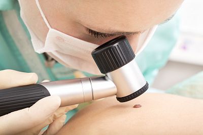 Los dermatólogos prevén que en 2030 se tripliquen los casos de melanoma en España