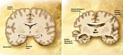 Desarrollan un método fiable con tecnología espacial para diagnosticar el alzheimer