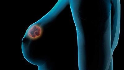 Detecten el càncer de mama a través de la IA