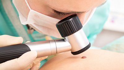 El diagnóstico de melanomas ha caído un 21% debido a la pandemia