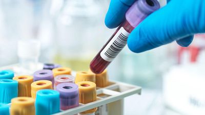 Un ensayo acerca la posibilidad de diagnosticar el alzhéimer con un análisis de sangre