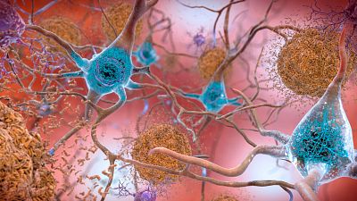 Un fármaco experimental muestra su eficacia contra el alzhéimer, pero se asocia a efectos secundarios graves